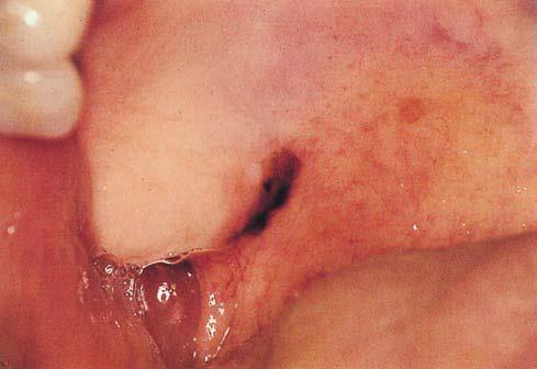 Ephelis Definition Ephelides, or freckles, are discrete brown macules, commonly seen on sun-exposed skin and rarely in the mouth. Etiology Unknown. They are due to increased melanin production.
