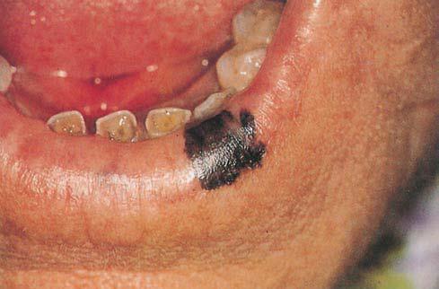 The vermilion border of the lower lip is the most common site of development. Treatment No treatment is required, except for aesthetic or diagnostic considerations.