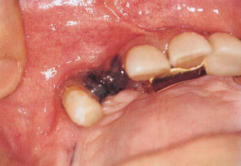 Clinically, the lesion appears as an asymptomatic, welldemarcated, flat or slightly elevated, brown, black, or blue spot or plaque. The lesion is usually solitary, with a diameter of less than 1 cm.