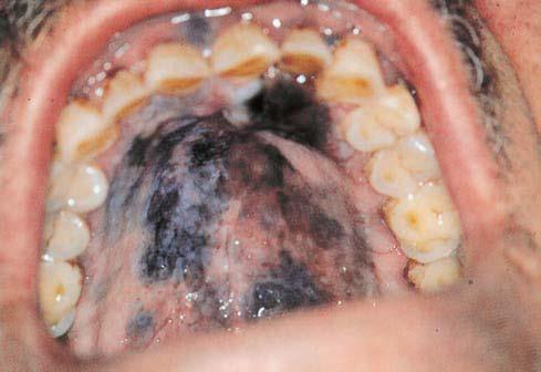Clinically, it presents as a black or brown macule, plaque, or nodule that may be ulcerated. The lesions are usually characterized by an irregular margin and a tendency to spread.