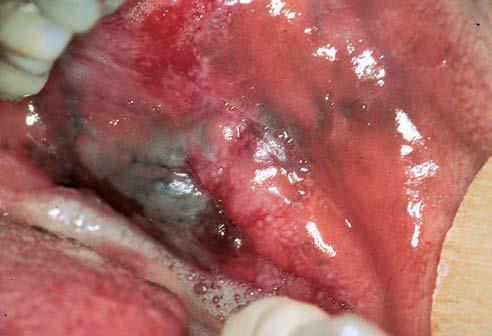 Clinical features The oral manifestations are common and early, and present as diffuse or patchy dark brown