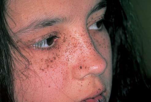 syndrome is a rare genetically transmitted disorder, characterized by mucocutaneous pigmentation and intestinal