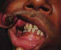 The perioral skin, lips, buccal mucosa, and tongue are the most common sites affected.