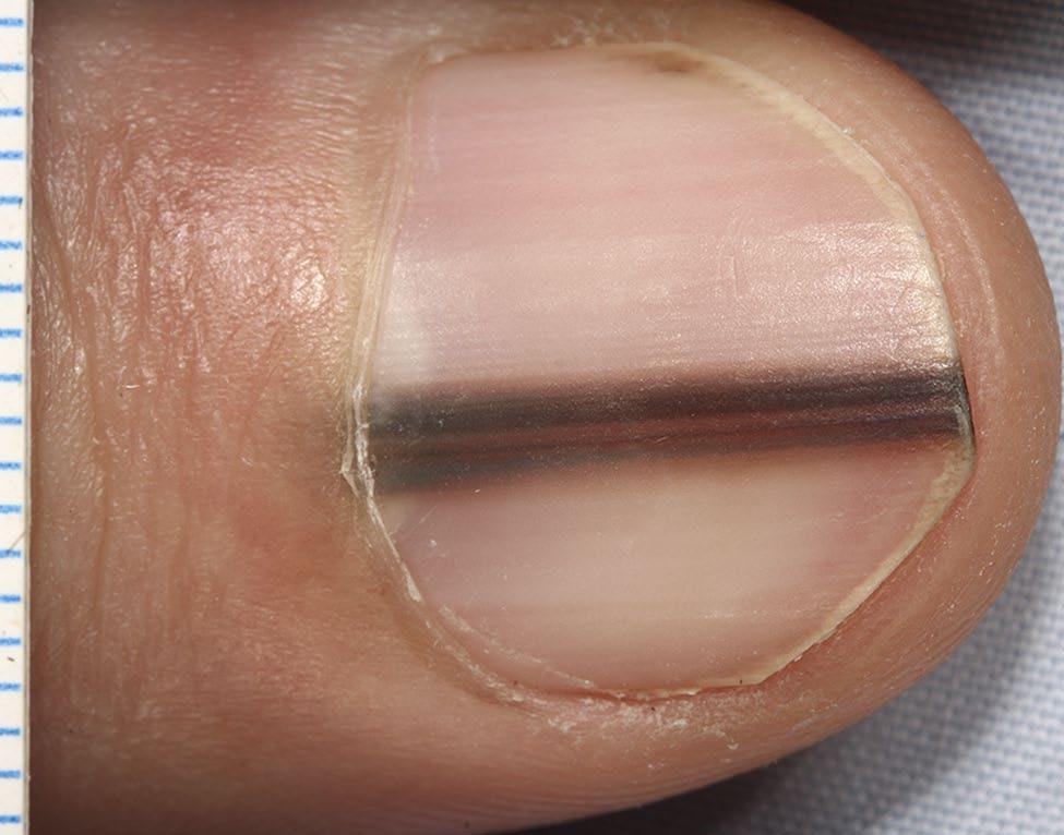 This pigment band on the nail plate appeared and widened over the preceding ten months.