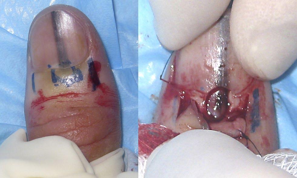 [Copyright: 2012 Rosendahl et al.] The patient had first noticed a fine band of pigment extending the full length of the nail 10 months earlier that had become progressively wider since then.