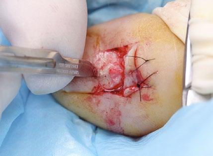 The cutting edge of the scalpel blade is directed outwards away from the nail matrix.