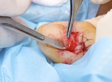 (G) The nail matrix containing the pigmented lesion is removed as an excision biopsy.