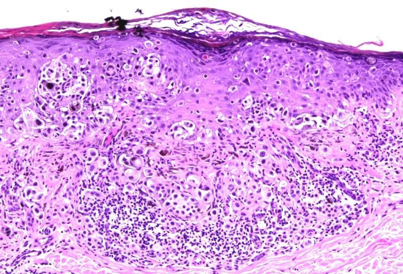 Superficial spreading (Pagetoid) melanoma The neoplastic melanocytes spreading upwards in the epidermis are large melanocytic
