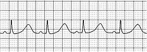 Step 4 Measure the Intervals (PR and QT) You have already learned how to do this! To review; Normal PR interval = 3-5 small boxes (0.12-0.20 sec) Clinical correlation: A long PR interval (> 0.