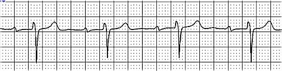 12 sec) can be a clue to the presence of a congenital accessory conduction pathway linking the atria and ventricles. This condition is called Wolff-Parkinson- White or WPW.