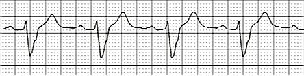 Pathologic Q waves Whenever the first deflection of the QRS complex is negative, it is called a Q wave.