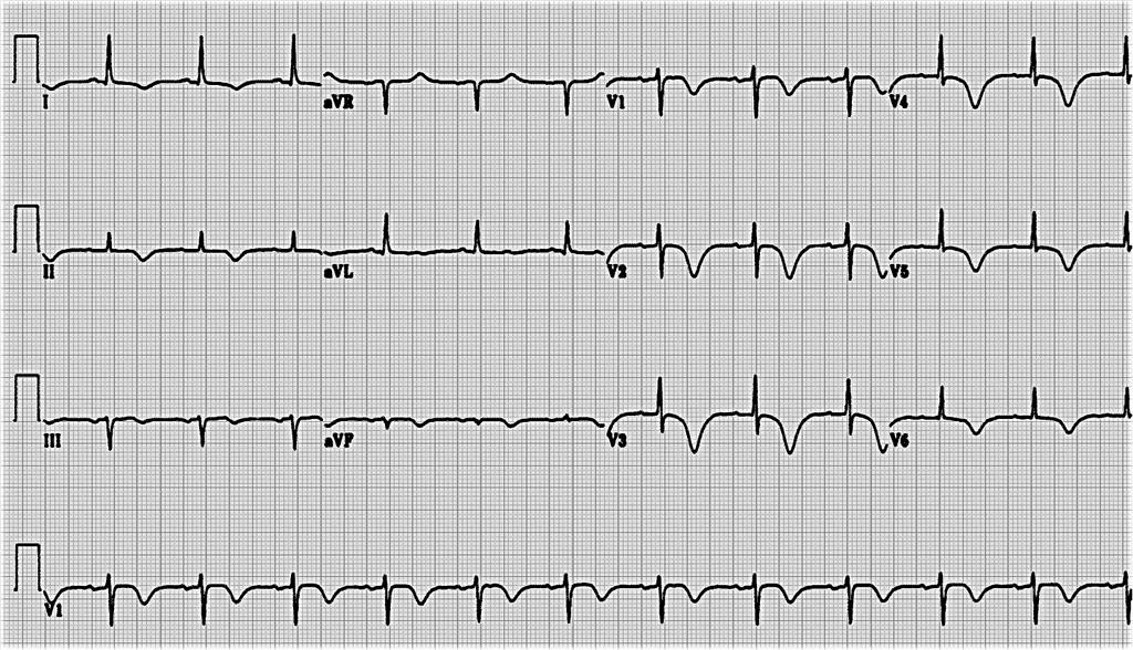 T wave T waves come in many shapes and sizes, but are normally upright in leads I and II and V3-V6, so an inverted (i.e. negative) T wave in these leads is always abnormal.