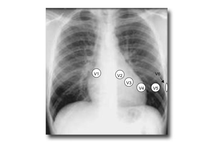 Placement of 10 separate ECG electrodes in standard locations on the chest and extremities allows the standard 12-Lead ECG to be recorded.