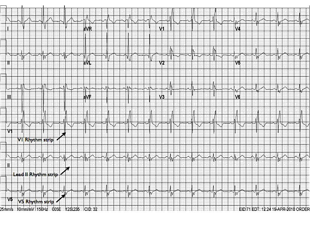 The 12-lead ECG There are many different formats for displaying the 12 lead ECG. Figure 4 shows one common format.