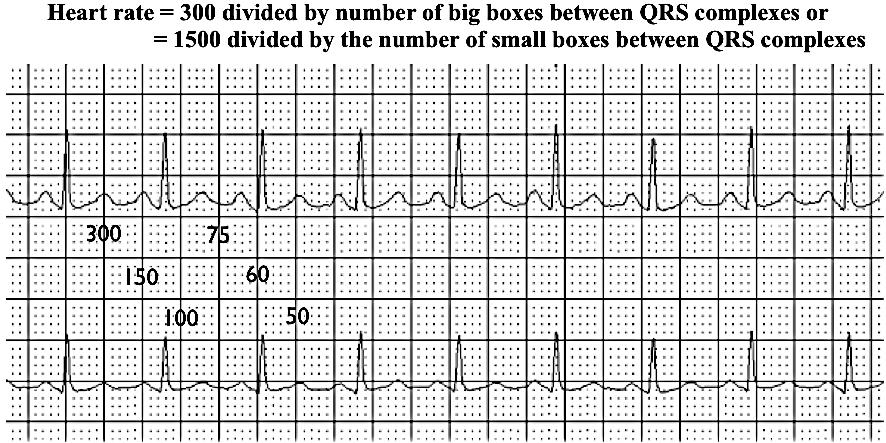 Step 1 Determine the Heart Rate Measuring heart rate is easy and can be done in a number of ways. The easiest is to count the number of large boxes between 2 successive QRS complexes.