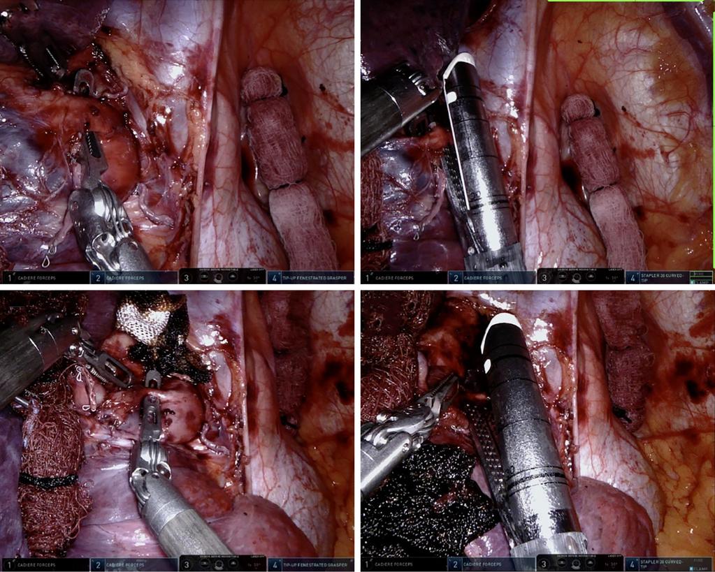 5360 Kim and han. Five on a dice robot lobectomy Figure 6 Right upper lobe branches of pulmonary artery.