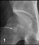 Bone island Common lesions in