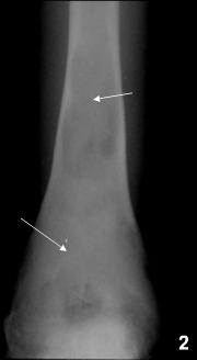 Fibrous dysplasia Areas of bone don t develop in normal bone forming cells, where there should be