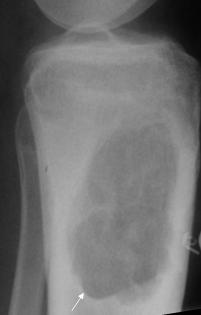 the well defined margin of the compartment within bone (white