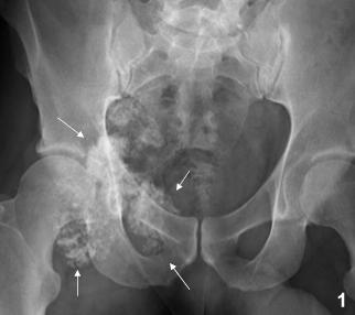 Chondrosarcoma Malignant tumor of cartilage It may go by itself as in patient 1 or arise in a