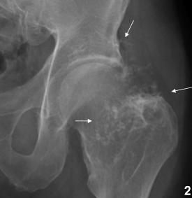 tumor calcification May be larger than visible coz of uncalcified cartilage The pelvis is a