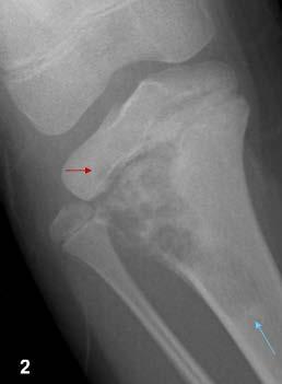 radiation therapy or those with Paget's disease May present with pathologic #