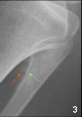 with knee region commonest site Bone destruction with ill defined margins, and