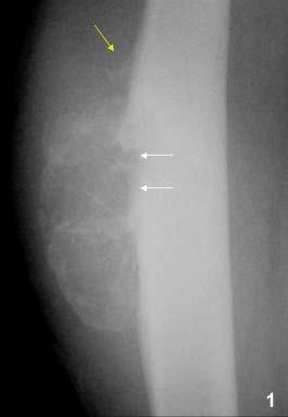 Osteosarcoma Comes in many variations Pt 1.
