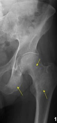 Bone metastases - sclerotic Commonest malignant bone tumor by huge margin Can be sclerotic in which new bone is made bcz