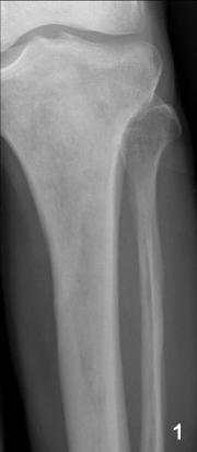 Generalized patchy increase in bone density throughout the tibia Img2: Prostate carcinoma