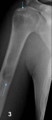 bone More common in children, in metaphyses as a well