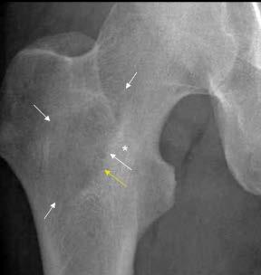 Indeterminate bone lesion Solitary area of ill-defined bone destruction in proximal femur in a 55 year old man Edge of lesion not well defined.