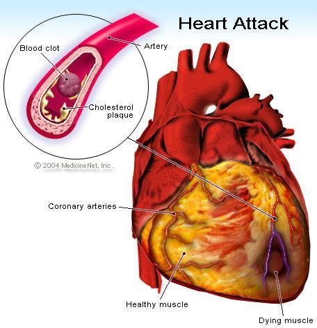 Heart Attack illustration - Coronary Artery Bypass Graft Surgery When arteries are narrowed in excess of 90 to 99%, patients often have accelerated angina or angina at rest (unstable angina).