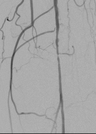 Angioplasty of the Popliteal Artery Primary