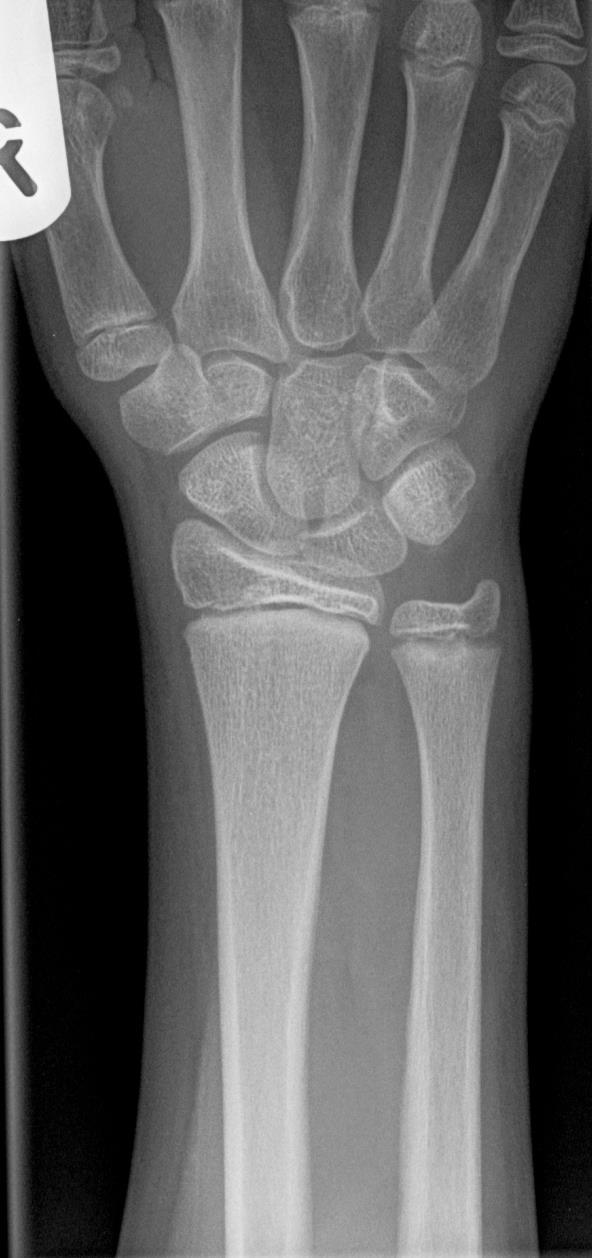 XRAY Plain radiography is not sensitive to the presence of osteomyelitis Bone