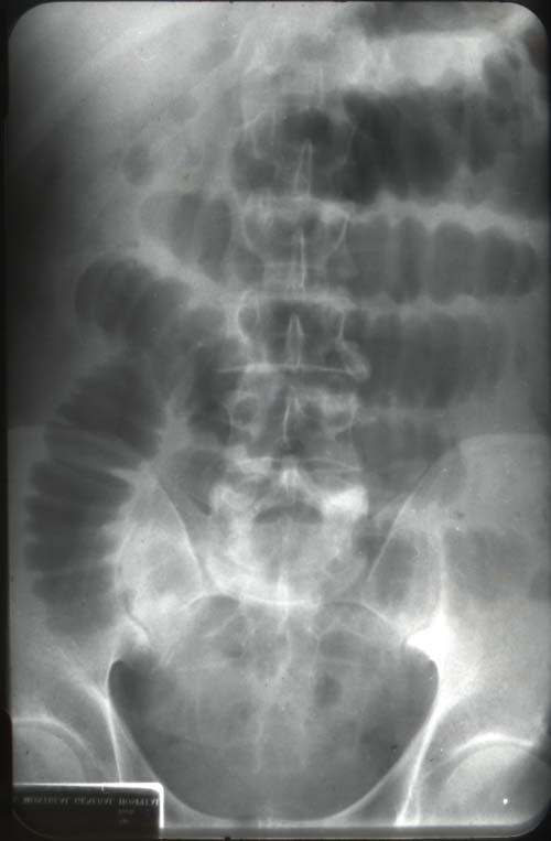 gastro management of complicated gallstone disease 12 complete) due to an impacted gallstone in the small bowel.