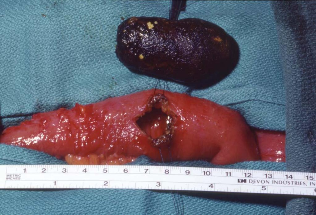 gastro management of complicated gallstone disease 13 Figure 11 Enterolithotomy for gallstone ileus. acalculous cholecystitis.