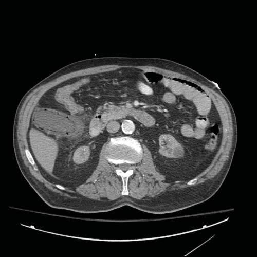 gastro management of complicated gallstone disease 3 or dislodged tubes or bleeding during installation occurs in approximately 16% of patients.