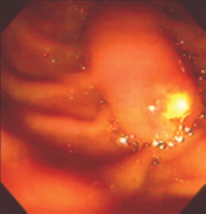 gastro management of complicated gallstone disease 7 acute pancreatitis, hemobilia (1.3%), and duodenal perforation (0.1 to 0.6%).