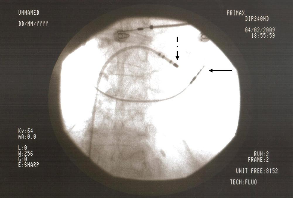 perirea venei cefalice stângi, sonda destinată VD a fost plasată în ventricul şi poziţionată pe septul interventricular în cazul sondelor cu fixare activă sau la vârful VD în cazul sondelor cu fixare