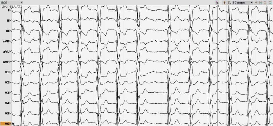 Romanian Journal of Cardiology each spline. With the reduced surface of each electrode (0.4 mm 2 ) and the small inter-electrode space of 2.