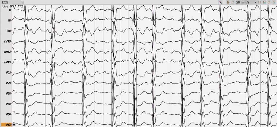 Romanian Journal of Cardiology Bogdan Enache et al. Figure 3. 12-lead ECG of the second Atrial Tachycardia, cycle length of 242 ms. Figure 4.