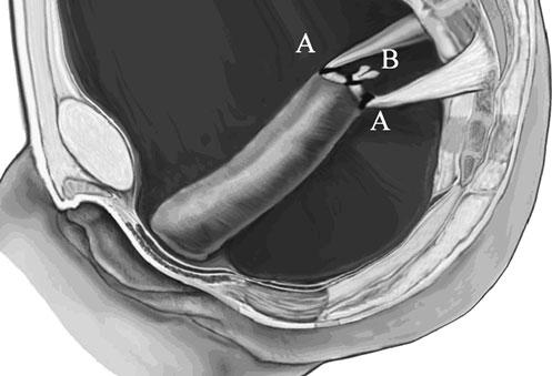 Int Urogynecol J (2011) 22:577 584 579 Fig. 3 Sagittal view of the vagina following hysterectomy, demonstrating the attachments for vault support.