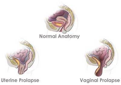 Genital Prolapse This lecture contains important informations for osce and theory exams so enjoy Definition of Genetal prolapse is the downward descent of the uterus and /or the vagina through the