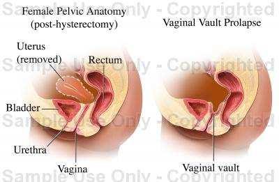 So vaginal prolapse either cystocele 'upper2/3 of ant wall' or urethrocele 'lower1/3 ant wall ' or rectocele 'post v wall ' or Enterocele or vault prolapse.