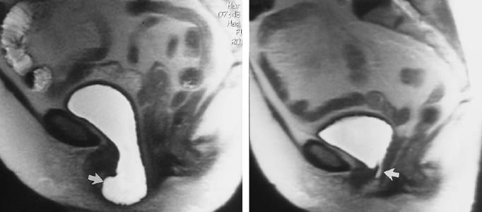 Interpretation of Imaging Findings: Middle Compartment Effects of Weakened Support Structures paracolpium: hysterectomy apical prolapse, (>1cm above PC line is normal at strain) cardinal or