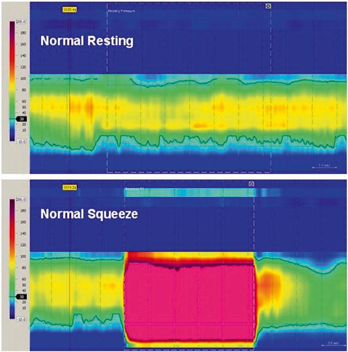 2 Overview of Testing of Motility and of the Anorectum 25 Fig. 2.1 High-resolution anorectal manometry: normal resting and squeeze.