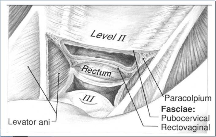 Pelvic floor support by DeLancey Level II: middle third vagina, supported by attachment of fascial sheet to pelvic