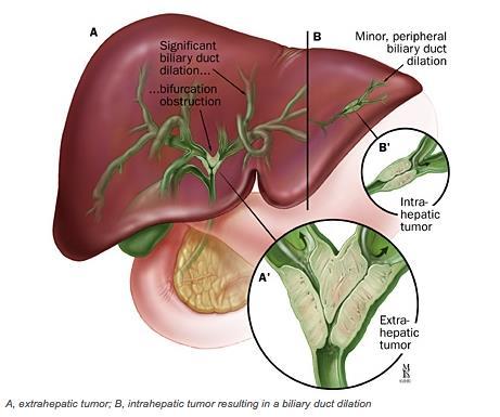 Cholangiocarcinoma: locations * * * * 2/3 involve the bifurcation of the common hepatic duct ( Klatskin tumors ) May also involve peripheral ducts Ductal dilation may occur
