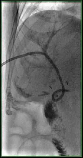 Our patient: PTC imaging series pre (1) and post (2,3) stent placement 1 2 3 1.